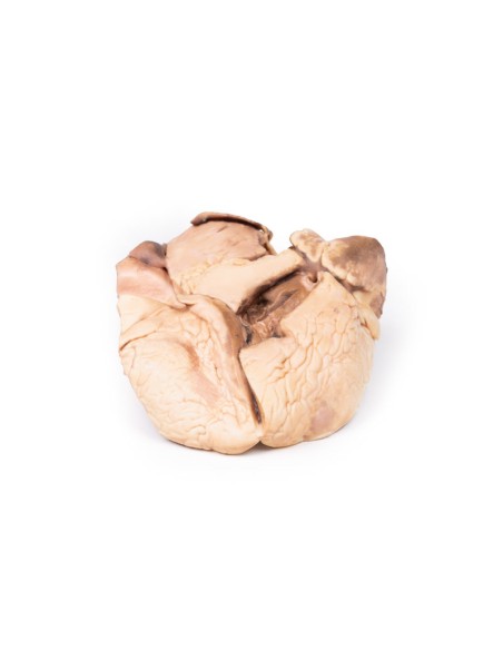 Rheumatische Endokarditis - Erler Zimmer 3D-Anatomie Serie MP2039