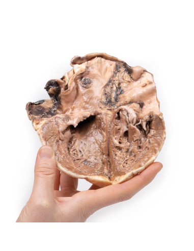 Endocardite rhumatismale - Erler Zimmer 3D...