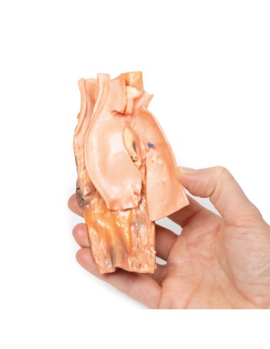 Fistola traumatica esofageo-aortica - Erler...