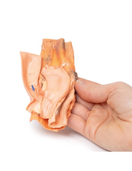 Fístula esofágico-aórtica traumática - Erler Zimmer 3D anatomy Series MP2040