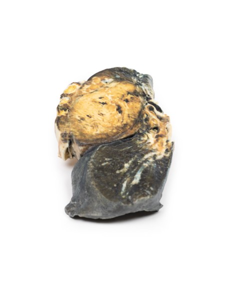 Metastatic tumor in the lung from primary testicular cancer - Erler Zimmer 3D anatomy Series MP2055