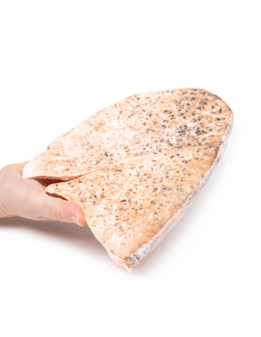 Tubercolosi miliare del polmone destro - Erler...