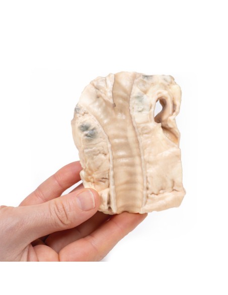 Luftröhre: Hodgkin-Lymphom - Erler Zimmer 3D-Anatomie Serie MP2062