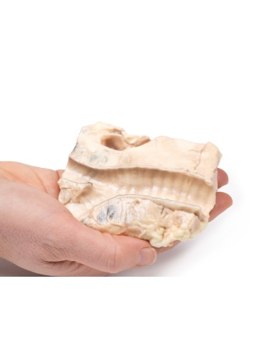 Trachea: linfoma di Hodgkin- Erler Zimmer 3D...