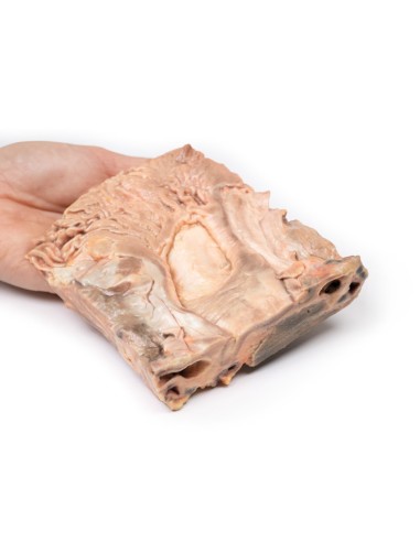 Ulcères gastriques chroniques - Erler Zimmer 3D...