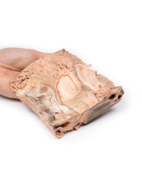 Chronic gastric ulcers - Erler Zimmer 3D anatomy Series MP2076