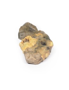 Pyonephrosis - Erler Zimmer 3D anatomy Series MP2096 2