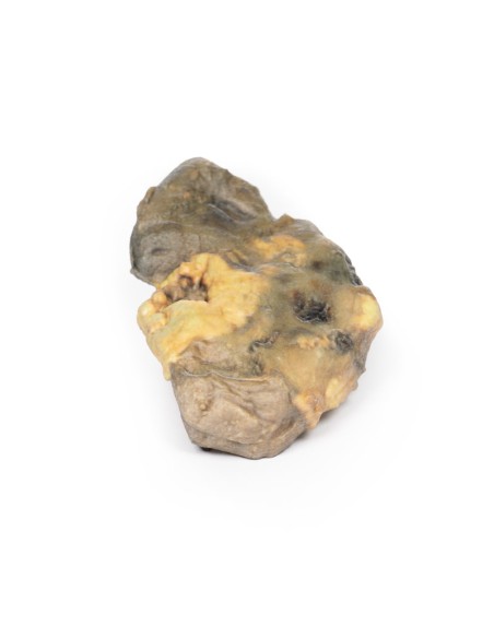 Pyonephrosis - Erler Zimmer 3D anatomy Series MP2096