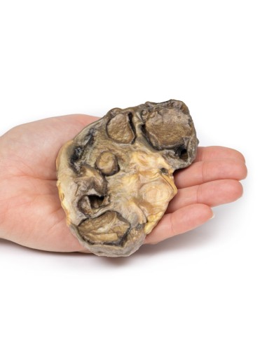 Pyonephrosis - Erler Zimmer 3D anatomy Series...