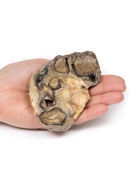 Pyonephrosis - Erler Zimmer 3D anatomy Series MP2096
