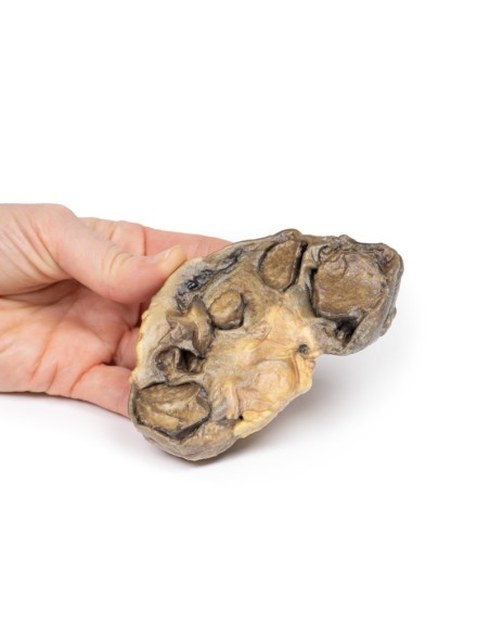Pyonephrosis - Erler Zimmer 3D anatomy Series MP2096