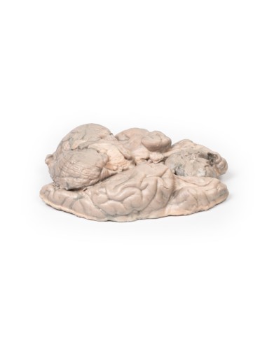 Meningioma - Erler Zimmer 3D anatomy Series MP2004