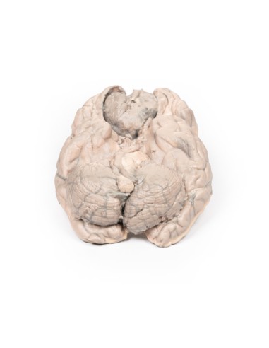 Meningioma - Erler Zimmer 3D anatomy Series MP2004