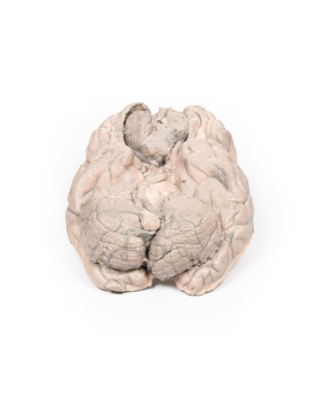 Meningeom - Erler Zimmer 3D-Anatomie Serie MP2004