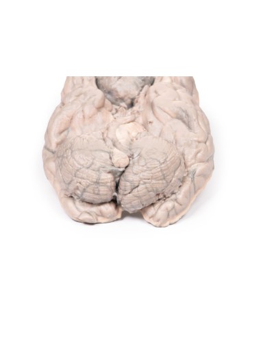 Meningeom - Erler Zimmer 3D-Anatomie Serie MP2004