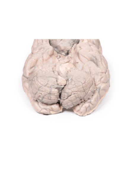 Meningioma - Erler Zimmer 3D anatomy Series MP2004