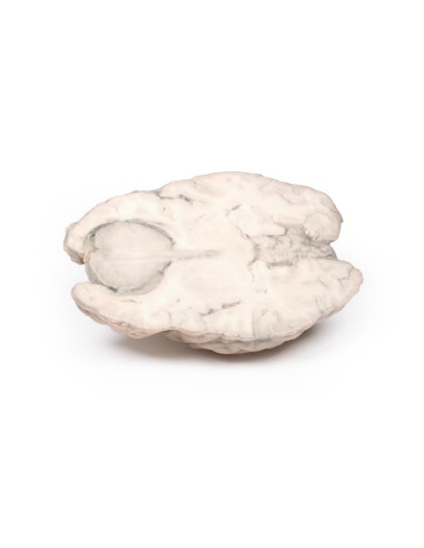 Meningioma - Erler Zimmer 3D anatomy Series MP2004