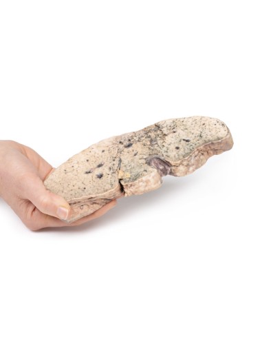 Cirrhose du foie - Erler Zimmer 3D anatomy...