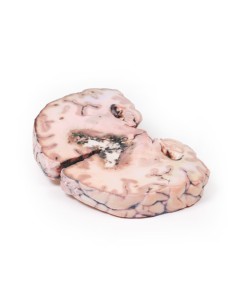 Grade 3-4 glioma that caused papilledema - Erler Zimmer... 2