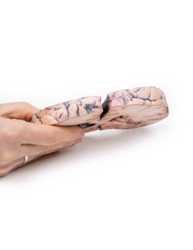 Gliome de grade 3-4 provoquant un œdème...