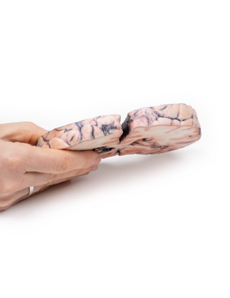 Glioma de grado 3-4 causante de papiledema - Erler Zimmer 3D anatomy Series MP2003