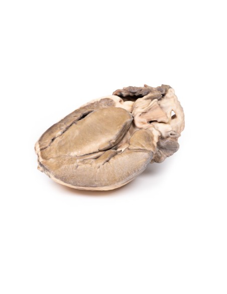 Stenosi subaortica ipertrofica - Erler Zimmer 3D anatomy Series MP2036