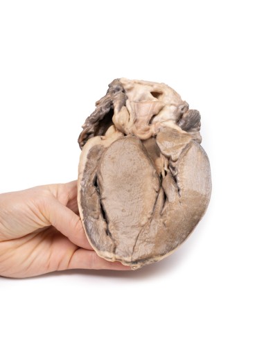 Hypertrophic subaortic stenosis - Erler Zimmer...