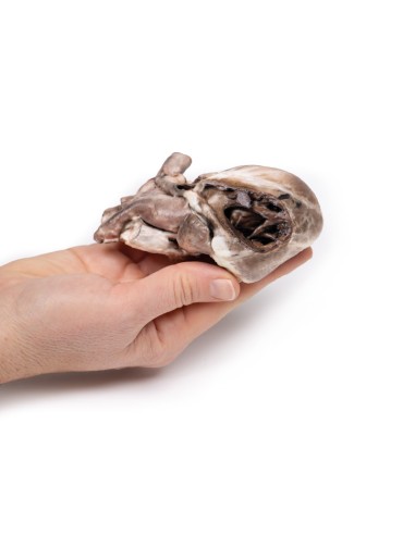 Tétralogie de Fallot - Erler Zimmer 3D anatomy...