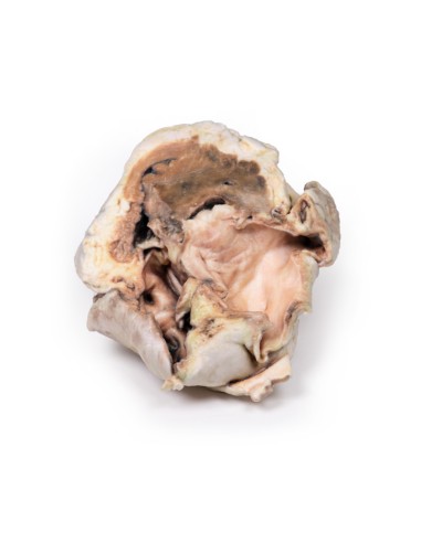 Stenosi valvolare aortica calcificata Valvola...