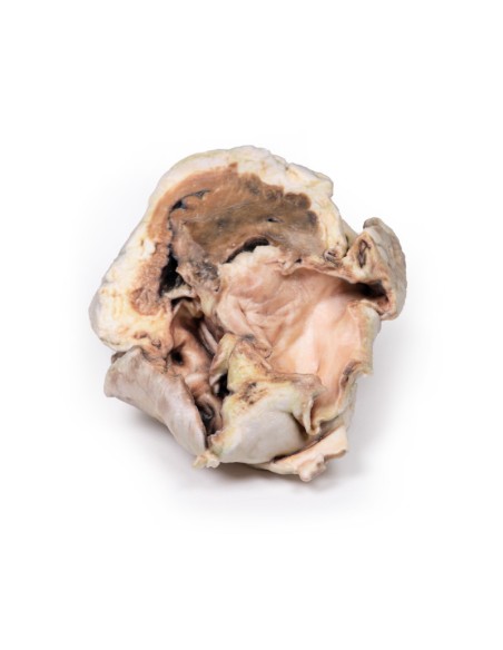 Stenosi valvolare aortica calcificata Valvola aortica bicuspide - Erler Zimmer 3D anatomy Series MP2038