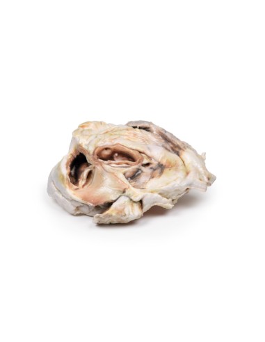 Sténose calcifiée de la valve aortique Valve...