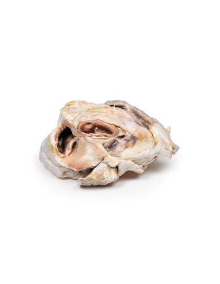 Calcified aortic valve stenosis Bicuspid aortic valve - Erler Zimmer 3D anatomy Series MP2038