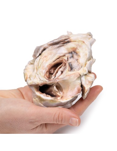 Stenosi valvolare aortica calcificata Valvola...