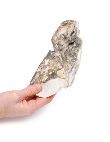 Tuberculose fibro-caséeuse - Erler Zimmer 3D...