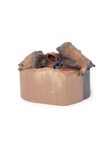 Espace péricardique - Erler Zimmer 3D anatomy...