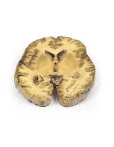 Ventriculitis, secondary to septicemia - Erler Zimmer 3D...