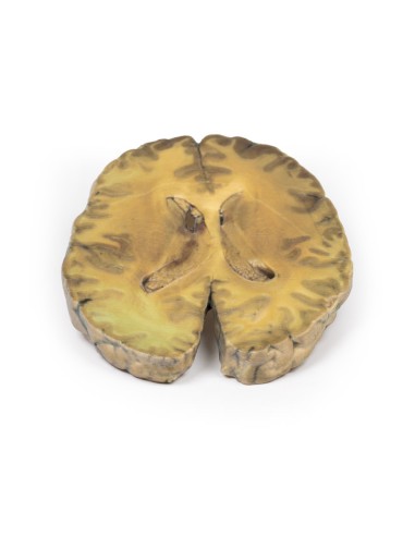 Ventriculitis secundaria a septicemia - Erler...