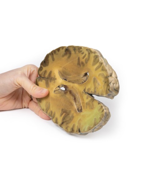 Ventriculitis, secondary to septicemia - Erler Zimmer 3D anatomy Series MP2008