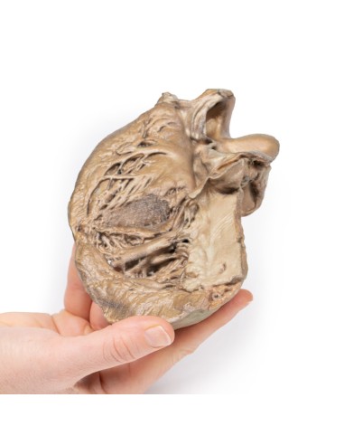 Bikuspidale Aortenklappe - Erler Zimmer 3D...