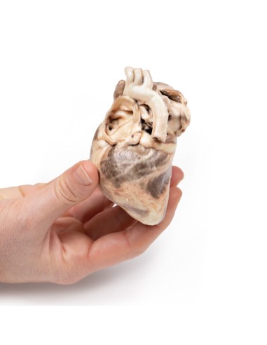 Kongenitale Pulmonalstenose - Erler Zimmer 3D...