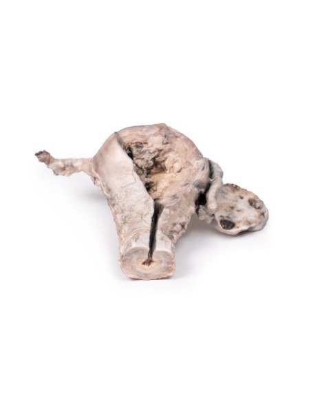 Endometrial Carcinoma - Erler Zimmer 3D anatomy Series MP2106