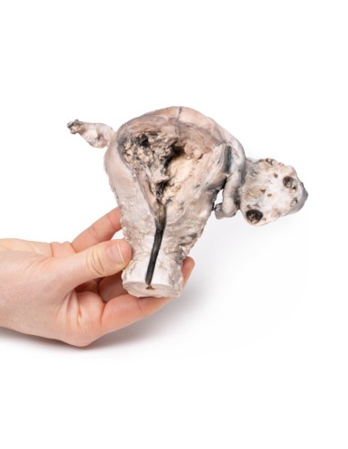 Endometrial Carcinoma - Erler Zimmer 3D anatomy...