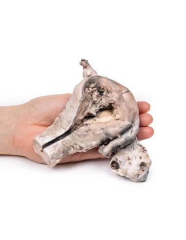 Endometriumkarzinom - Erler Zimmer 3D-Anatomie...