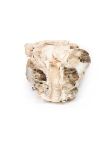 Multinoduläre Struma - Erler Zimmer 3D Anatomie...