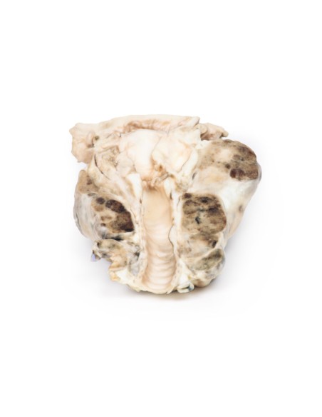 Gozzo multinodulare - Erler Zimmer 3D anatomy Series MP2101