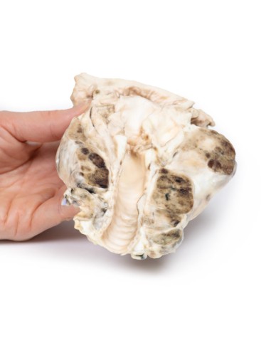 Goitre multinodulaire - Erler Zimmer 3D anatomy...