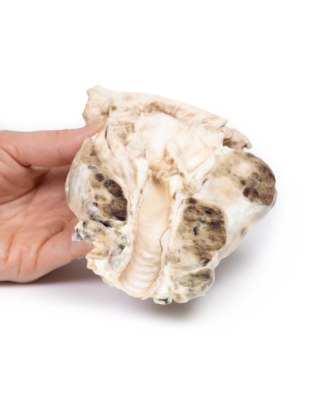 Multinoduläre Struma - Erler Zimmer 3D Anatomie Serie MP2101