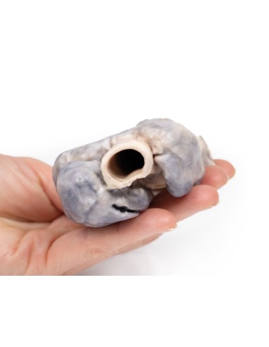 Retrosternal goiter - Erler Zimmer 3D anatomy...