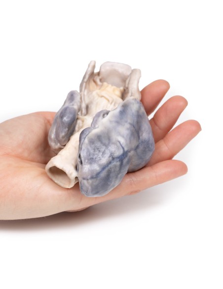 Retrosternal goiter - Erler Zimmer 3D anatomy Series MP2102