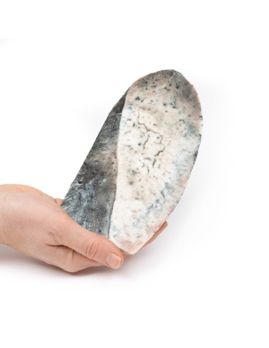 Polmonite lobare - Fase di epatizzazione grigia...